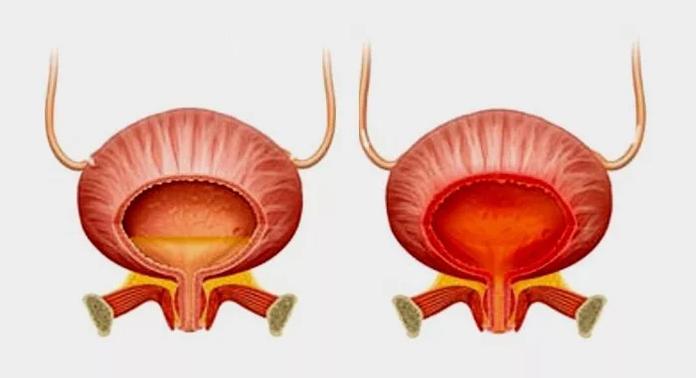 Vessie normale (à gauche) et inflammation de la vessie avec cystite (à droite)